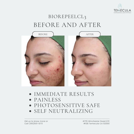 Unlock Radiant Skin with BioRePeel at Temecula Hormone and Aesthetics