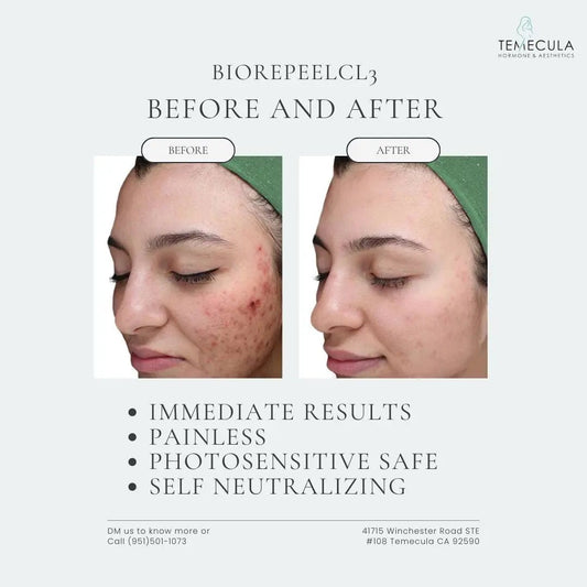 Unlock Radiant Skin with BioRePeel at Temecula Hormone and Aesthetics - Temecula Hormone & Aesthetics