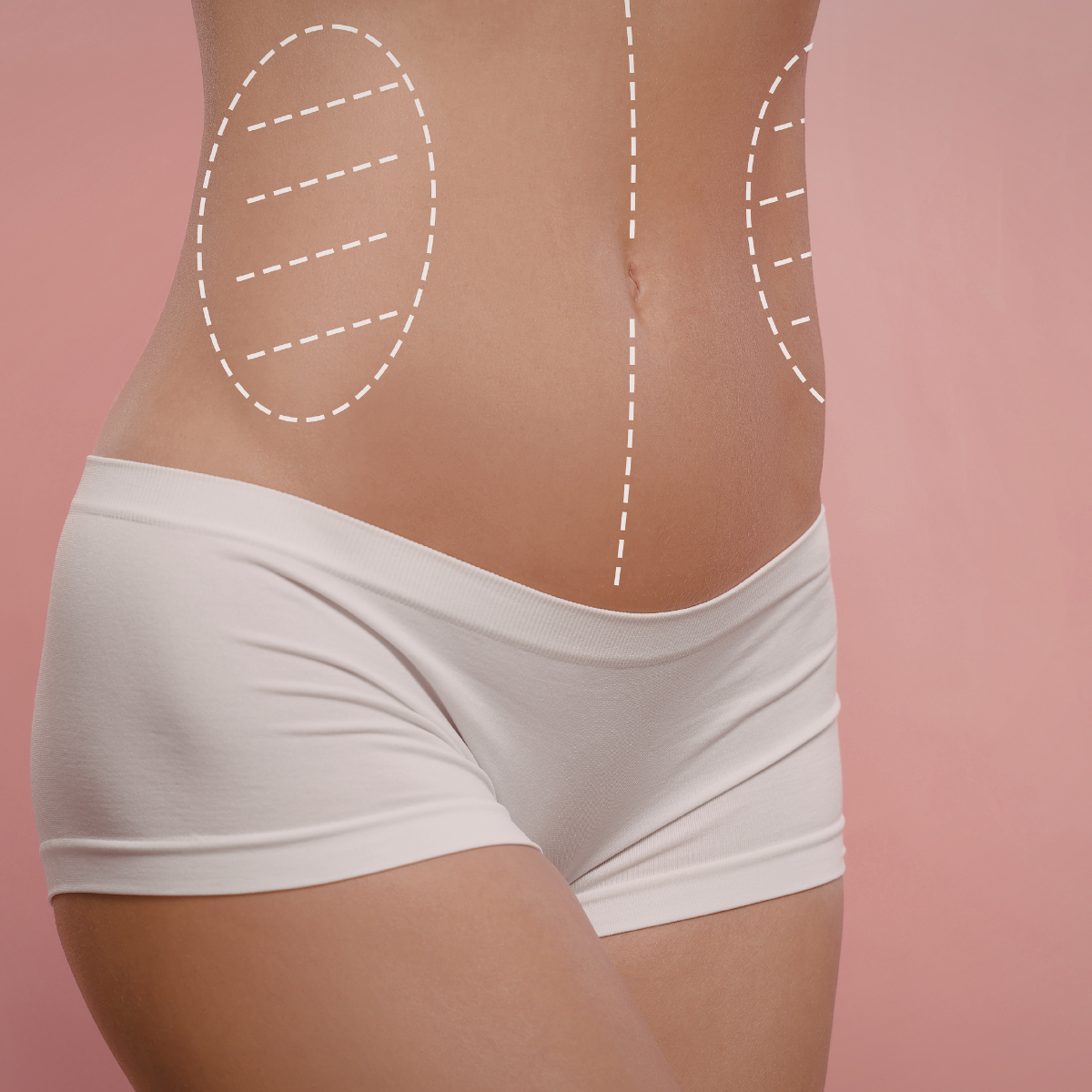 Endymed Pure Body Contouring & Cellulite Reduction at Temecula Hormone & Aesthetics Temecula Hormone & Aesthetics