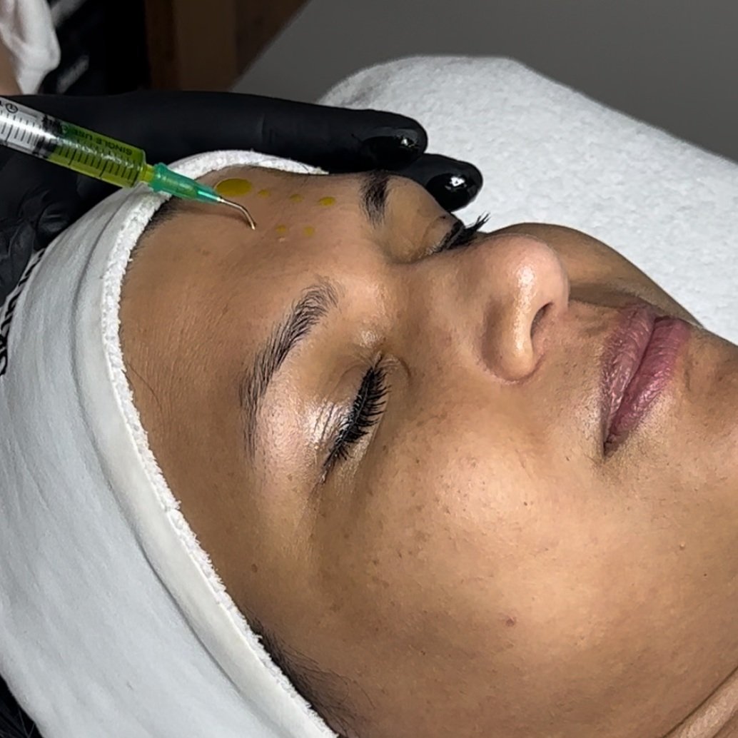 Chemical Peels