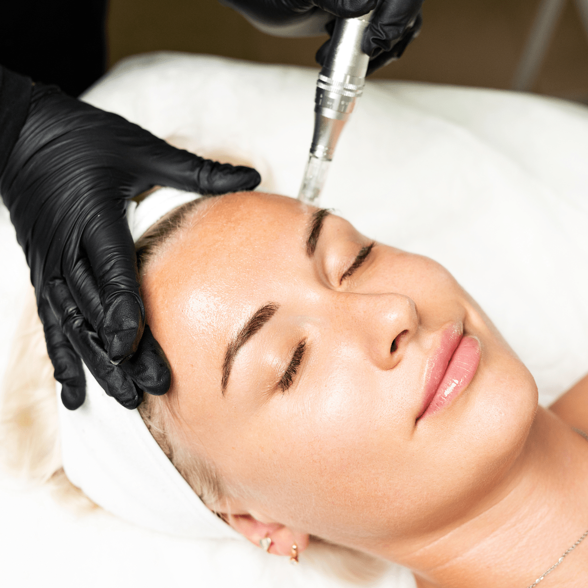 Microneedling at Temecula Hormone & Aesthetics - Temecula Hormone & Aesthetics