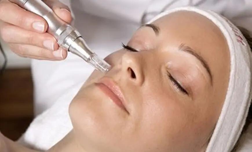 NanoNeedling at Temecula Hormone & Aesthetics - Temecula Hormone & Aesthetics