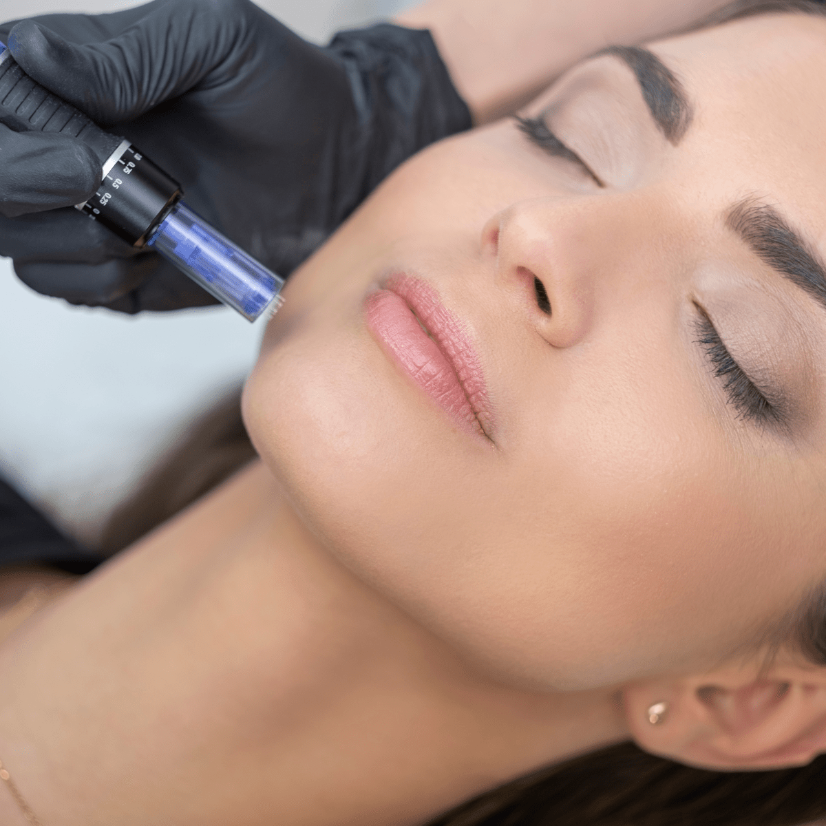 NanoNeedling at Temecula Hormone & Aesthetics - Temecula Hormone & Aesthetics