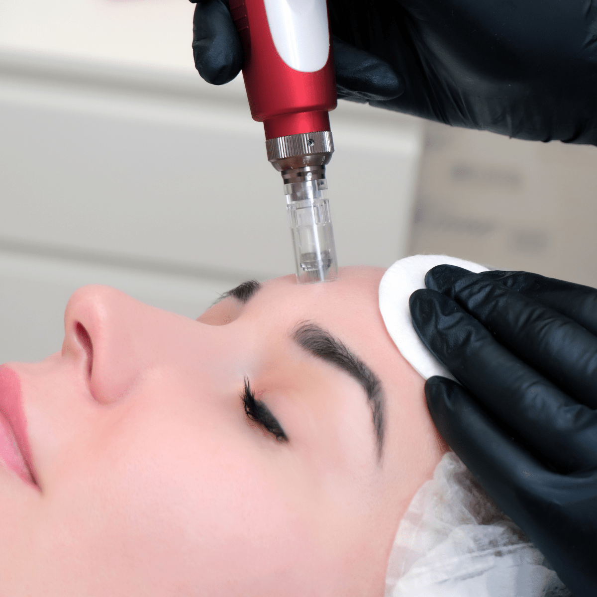 NanoNeedling at Temecula Hormone & Aesthetics - Temecula Hormone & Aesthetics